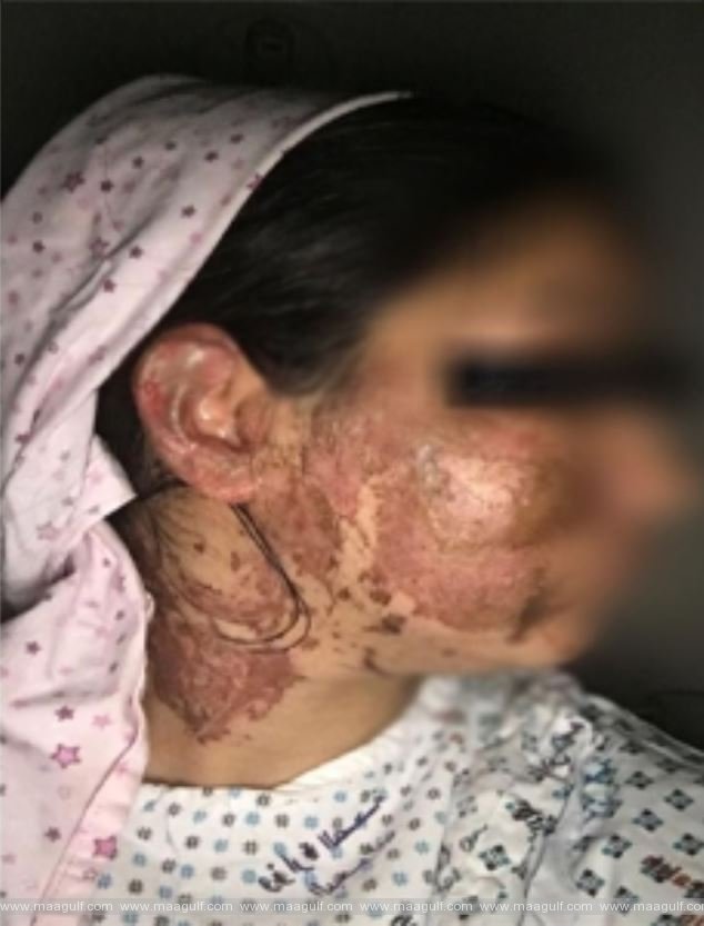 మాజీ భార్యపై యాసిడ్ దాడికి పాల్పడిన నిందితుడు