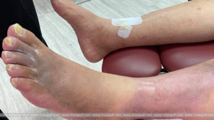 భారత్ కు తలనొప్పిగా మరో వ్యాధి..కరోనా నుండి కోలుకున్నవారికే