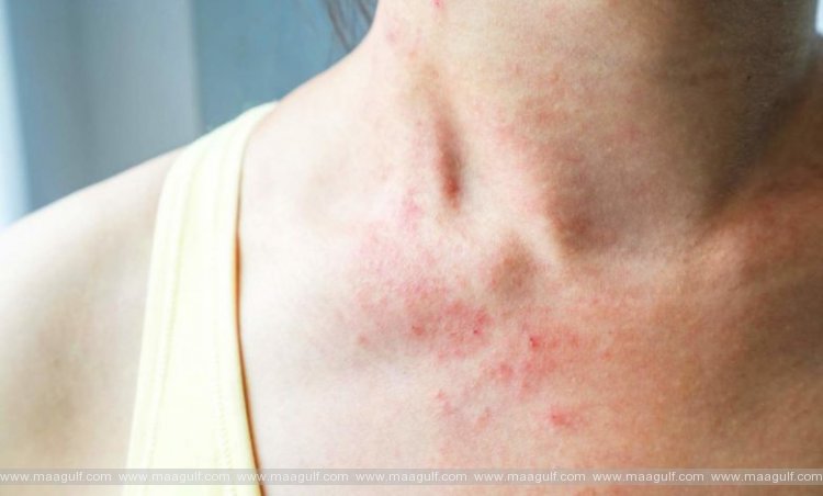 ‘కాస్మెటిక్’ వినియోగానికి ముందు అలెర్జీ పరీక్షలు మస్ట్