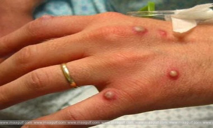 ఇజ్రాయెల్‌లో మొదటి మంకీపాక్స్ కేసు