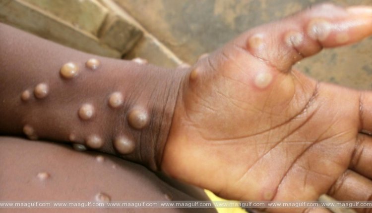 మంకీపాక్స్.. వేగంగా విస్తరిస్తోన్న వైరస్..