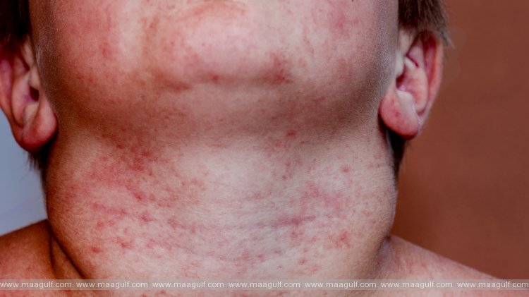 వేసవిలో వచ్చే చెమట పొక్కులు తగ్గాలంటే ఇలా చేయండి..