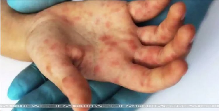 టొమాటో ఫ్లూపై UAE వైద్యుల నిఘా