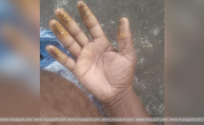 1 పట్టుబడిన ఫింగర్ ప్రింట్స్ సర్జరీ మాఫియా