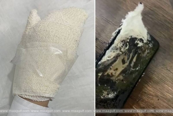 1 మొబైల్ ఫోన్కు మంటలు.. సౌదీ యువతికి గాయాలు