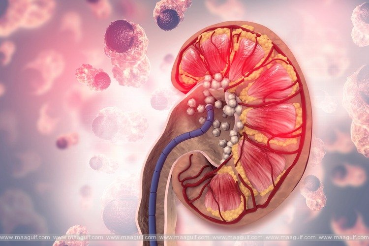 కిడ్నీ స్టోన్స్‌కి తమలపాకుతో ఉపశమనం.!