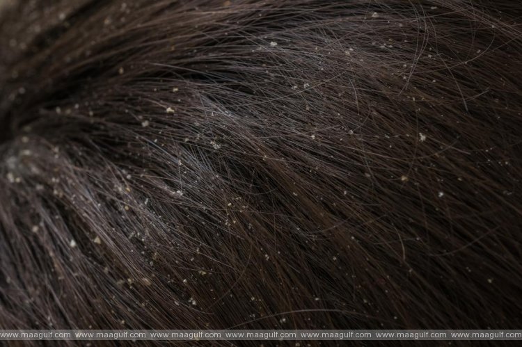డేండ్రఫ్ (చుండ్రు) సమస్యకు ఇంటి చిట్కా.!