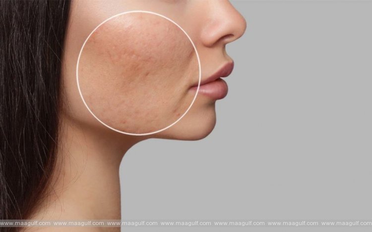 మొటిమల వల్ల కలిగే గుంతలు తగ్గాలంటే.!