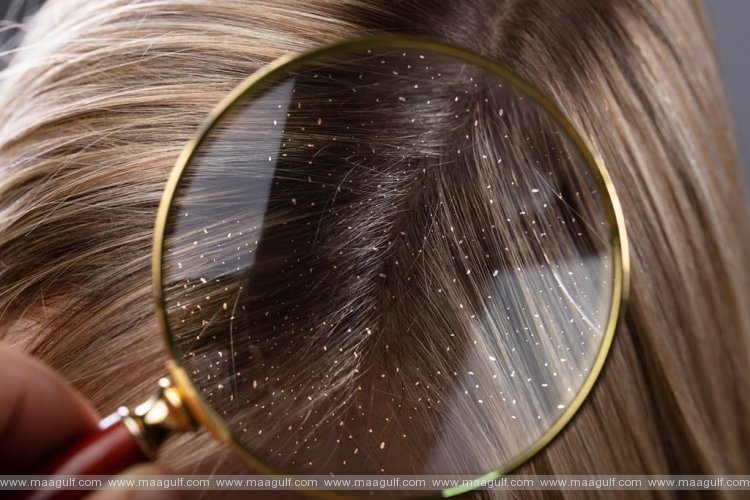 తలలో చుండ్రు బాగా వేధిస్తోందా.? మీకోసమే ఈ చిన్న టిప్.!