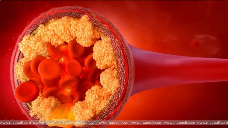 11 బ్యాడ్ కొలెస్ట్రాల్ని తగ్గించుకోవడమెలా?