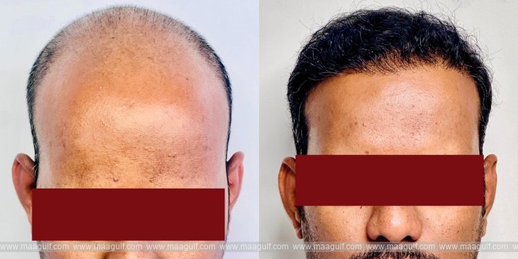 మెడికవర్ హాస్పిటల్స్ లో  హెయిర్ ట్రాన్స్‌ప్లాంటేషన్ విజయవంతం