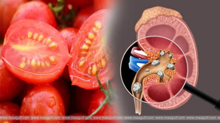 11 కిడ్నీ స్టోన్స్కి టమాటా ఓ కారణమా.?
