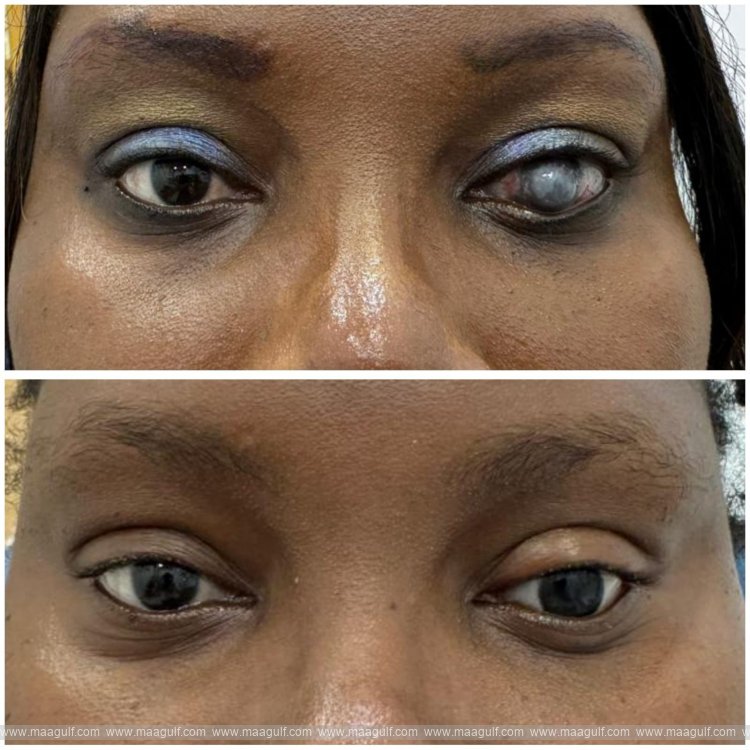 Ocular Prosthesis Surgery at Aster Hospital Al Qusais Helps 42-Year-Old Patient from Congo