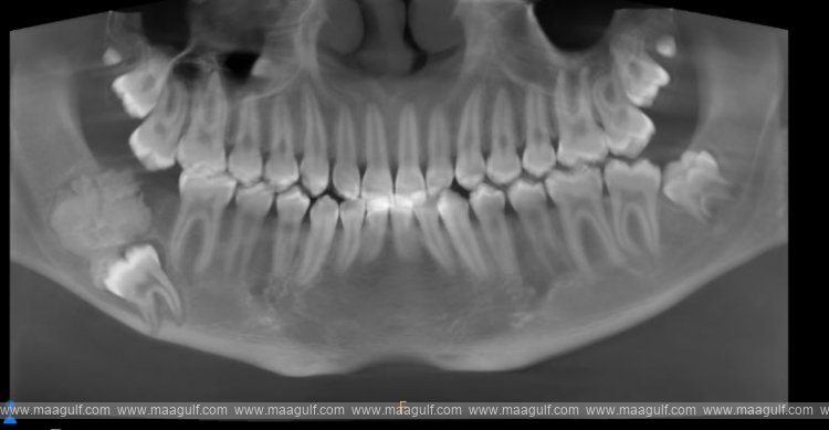 Medcare Dentofaces gives Arab teenager with rare jaw tumour a new lease on life