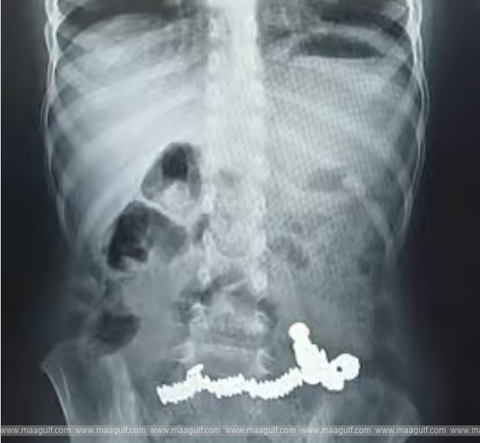 5-year-old-swallows-52-magnets-uae-doctors-warn-of-hidden-risks-to-children
